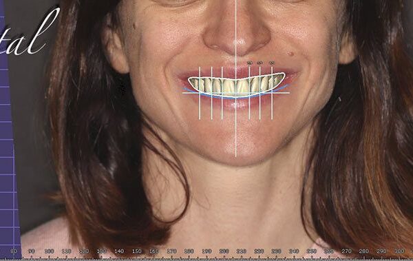 Diseno_sonrisa_digital_Dental_Cad_Screenshot_07